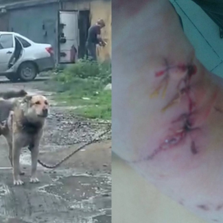 Пятый пострадавший от собаки: «Ладно шею прикрыл, а так бы она меня убила!»
